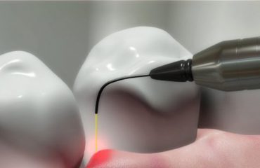 Dental-Lasers-q1upkmhexjtk7obqoojh37eqilc4sowediv76u5gps