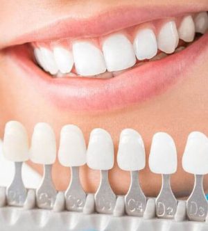 Teeth_Whitening