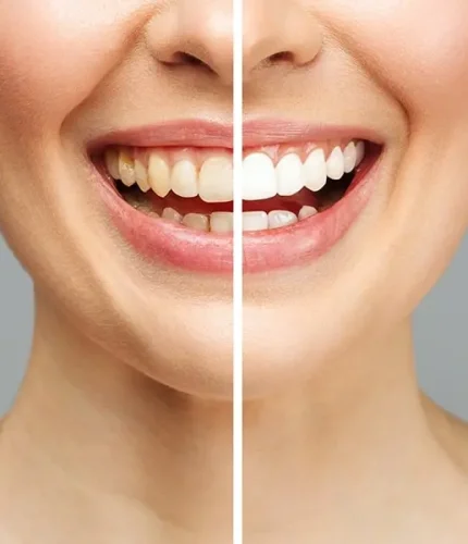 Teeth_Whitening_Image