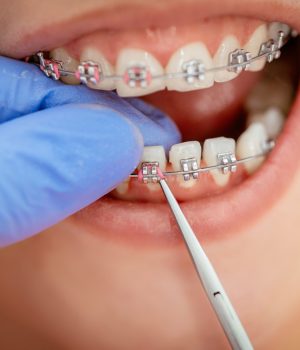 The-Orthodontic-Treatment-Process-A-Step-By-Step-Guide