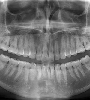 Dental x-ray, showing all teeth