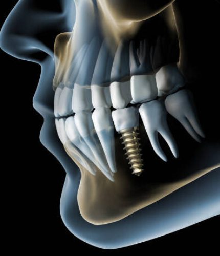 Close-up of a dental implant with crown in the lower jaw against a dark background - 3D illustration