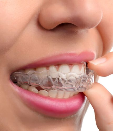 pros-and-cons-of-invisalign