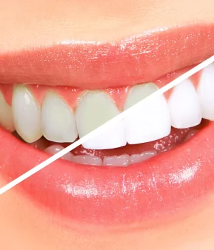 teeth-whitening3-scaled