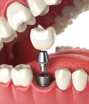 types-of-dental-implants-which-one-is-best-for-you